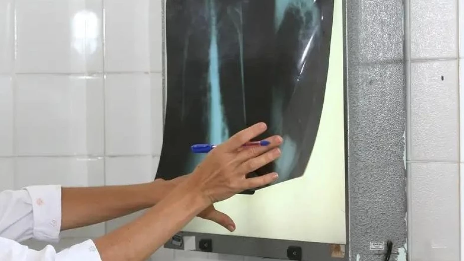 Taubaté intensifica busca ativa por casos de tuberculose até o fim de setembro