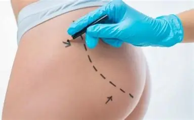 Alta nos procedimentos de lifting de bumbum acende alerta para riscos da cirurgia estética