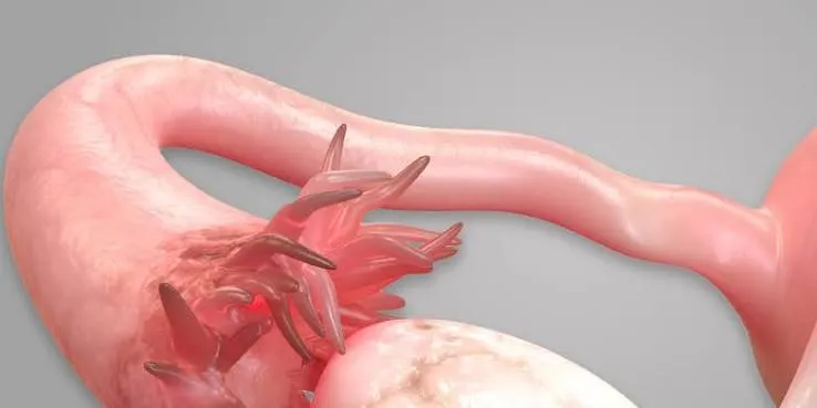 Trompas uterinas desempenham papel fundamental na fecundação e podem apresentar alterações difíceis de identificar