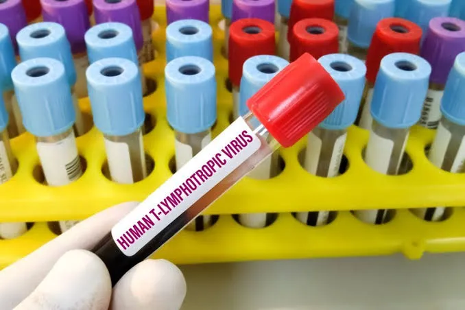 Estudo brasileiro utiliza vírus HTLV-1 para investigar esclerose múltipla progressiva